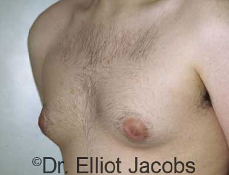 Male breast, before Gynecomastia treatment, l-side oblique view - patient 15