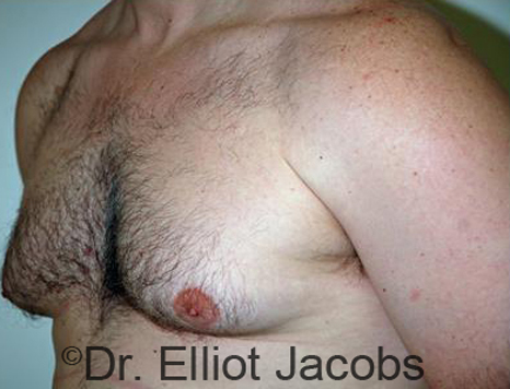Male body, before Torsoplasty treatment, l-side oblique view, patient 19