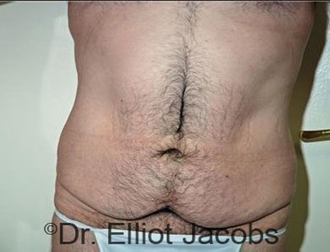 Male body, before Torsoplasty treatment, front view, patient 20