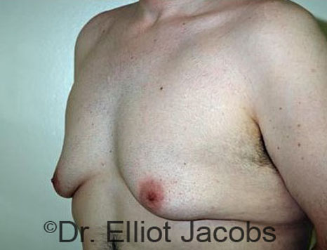 Male body, before Torsoplasty treatment, l-side oblique view, patient 20