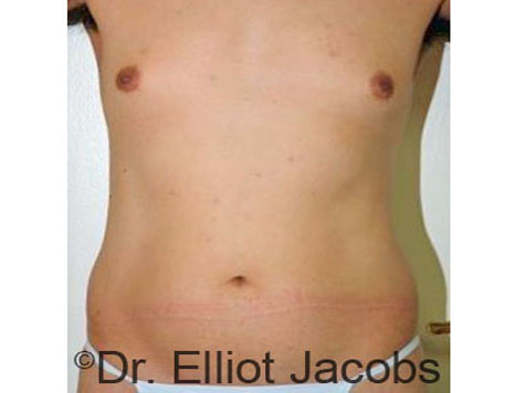 Male body, before Torsoplasty treatment, front view, patient 21