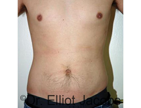 Male body, before Torsoplasty treatment, front view, patient 22