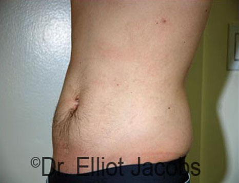 Male body, before Torsoplasty treatment, l-side oblique view, patient 22