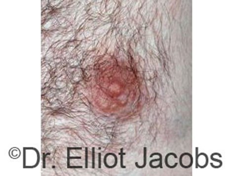 Male nipple, before Peri-Areolar Scars treatment, front view - patient 1