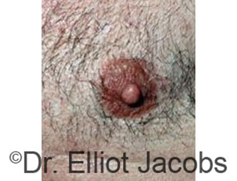 Male nipple, before Peri-Areolar Scars treatment, front view - patient 2