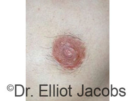 Male nipple, before Peri-Areolar Scars treatment, front view, patient 3
