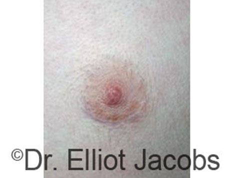 Male nipple, before Peri-Areolar Scars treatment, front view, patient 6