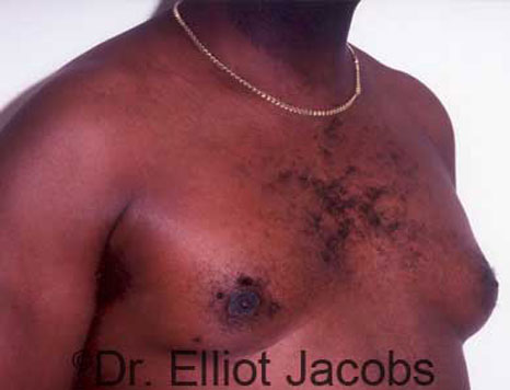 Male breast, before Treatment of Male Chest Asymmetry, oblique view, patient 1