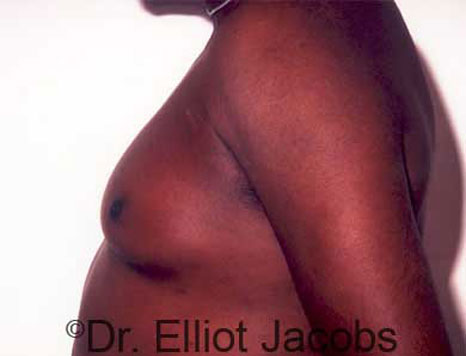 Male breast, before Gynecomastia treatment, l-side view - patient 16