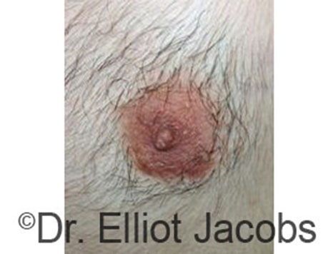 Male nipple, before Peri-Areolar Scars treatment, front view - patient 9