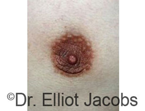 Male nipple, before Peri-Areolar Scars treatment, front view - patient 10