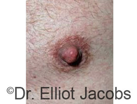 Male nipple, before Peri-Areolar Scars treatment, front view, patient 15