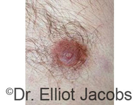 Male nipple, before Peri-Areolar Scars treatment, front view - patient 16