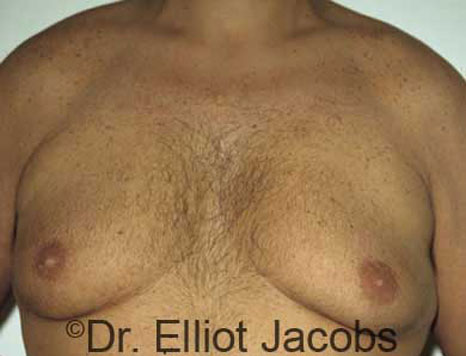 Male breast, before Gynecomastia treatment, front view, patient 17