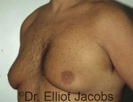 Male breast, before Gynecomastia treatment, l-side oblique view - patient 17