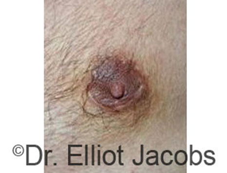 Male nipple, before Peri-Areolar Scars treatment, front view, patient 17