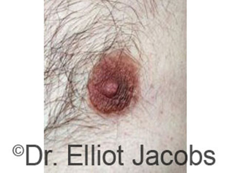 Male nipple, before Peri-Areolar Scars treatment, front view - patient 18