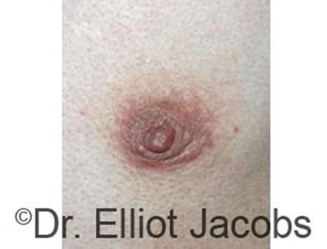 Male nipple, before Peri-Areolar Scars treatment, front view - patient 22