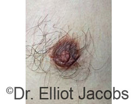 Male nipple, before Peri-Areolar Scars treatment, front view - patient 23