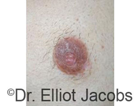 Male nipple, before Peri-Areolar Scars treatment, front view - patient 24