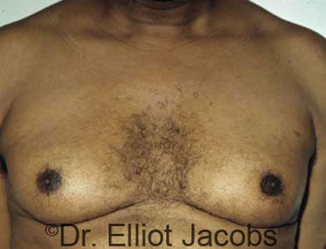 Male breast, before Gynecomastia treatment, front view, patient 18