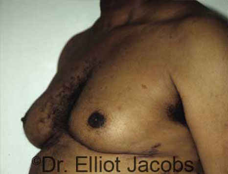 Male breast, before Gynecomastia treatment, l-side oblique view - patient 18