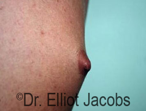 Male nipple, before Puffy Nipple treatment, r-side view - patient 3