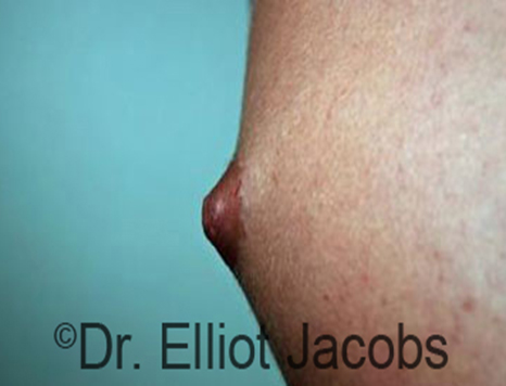 Male nipple, before Puffy Nipple treatment, l-side view - patient 3