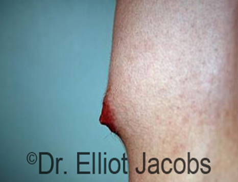 Male nipple, before Puffy Nipple treatment, l-side view - patient 7