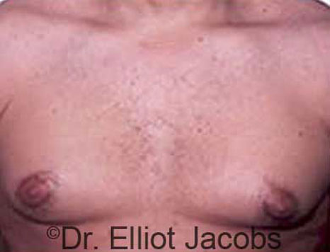Male breast, before Gynecomastia treatment, front view, patient 19