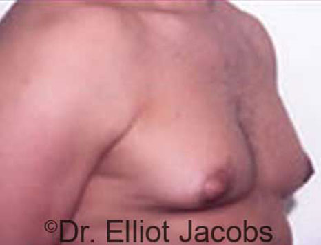 Male breast, before Gynecomastia treatment, r-side oblique view - patient 19