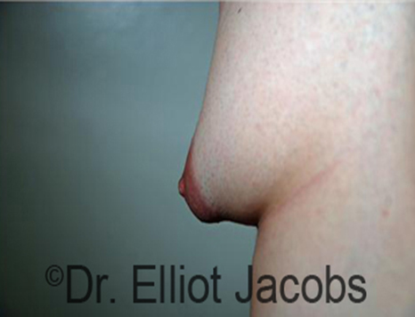 Male nipple, before Puffy Nipple treatment, l-side view - patient 14