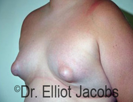 Male breast, before Puffy Nipple Reduction treatment, oblique view, patient 1