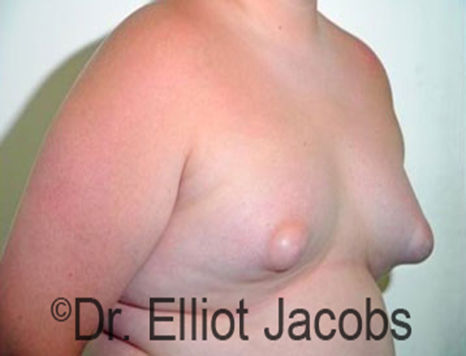 Male nipple, before Puffy Nipple treatment, r-side oblique view - patient 15