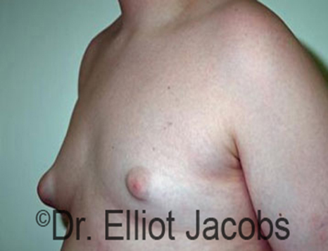 Male nipple, before Puffy Nipple treatment, l-side oblique view - patient 16