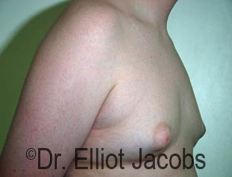 Male nipple, before Puffy Nipple treatment, r-side oblique view - patient 16