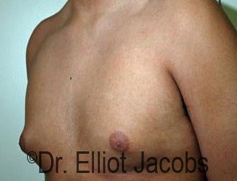 Male nipple, before Puffy Nipple treatment, l-side oblique view - patient 17