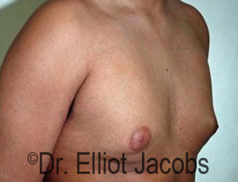 Male nipple, before Puffy Nipple treatment, r-side oblique view - patient 17