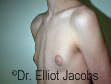 Male nipple, before Puffy Nipple treatment, l-side oblique view - patient 18