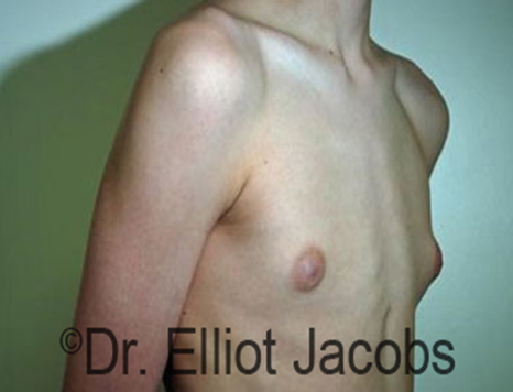 Male nipple, before Puffy Nipple treatment, r-side oblique view - patient 18