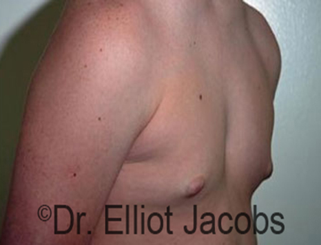 Male nipple, before Puffy Nipple treatment, r-side oblique view - patient 19