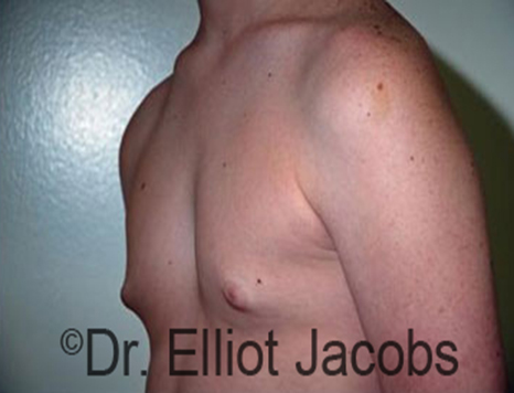 Male nipple, before Puffy Nipple treatment, l-side oblique view - patient 19