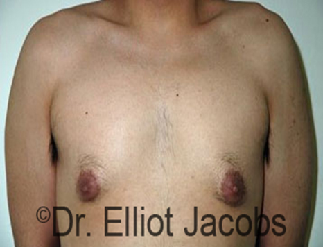 Male nipple, before Puffy Nipple treatment, front view - patient 20