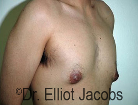 Male nipple, before Puffy Nipple treatment, r-side oblique view - patient 20