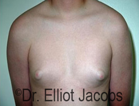 Male nipple, before Puffy Nipple treatment, front view - patient 21