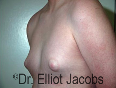 Male nipple, before Puffy Nipple treatment, l-side oblique view - patient 21