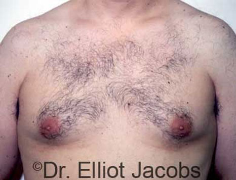 Male breast, before Gynecomastia treatment, front view, patient 2