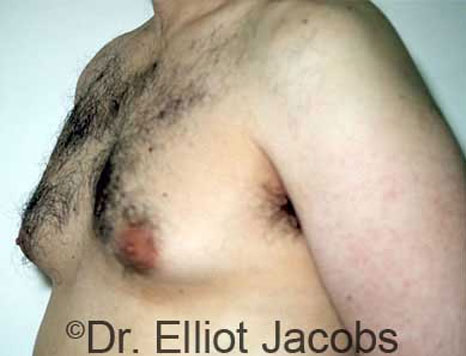 Male breast, before Gynecomastia treatment, l-side oblique view, patient 2