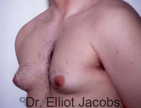 Male breast, before Gynecomastia treatment, l-side oblique view - patient 20