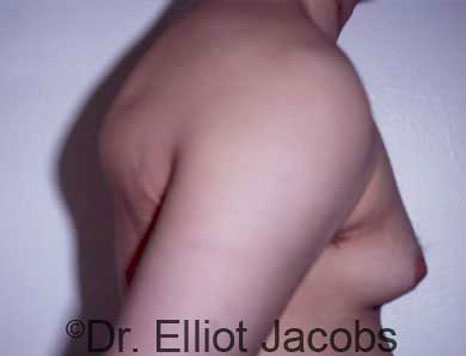 Male breast, before Gynecomastia treatment, r-side view - patient 20